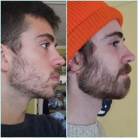Minoxidil Beard Progress Reddit