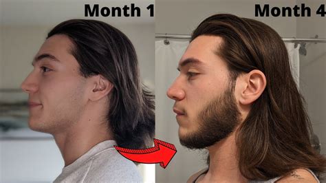Minoxidil Beard Transformation