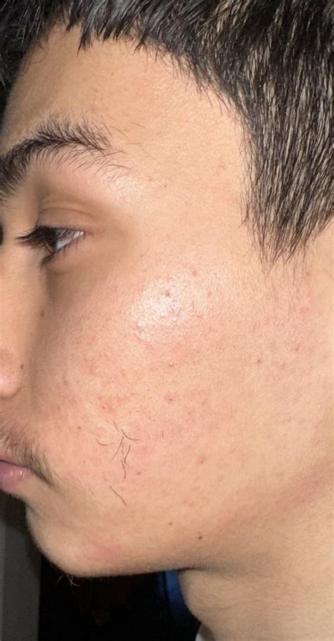 Minoxidil Beards Reddit