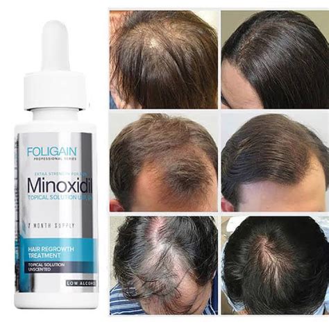 Minoxidil Extra Strength