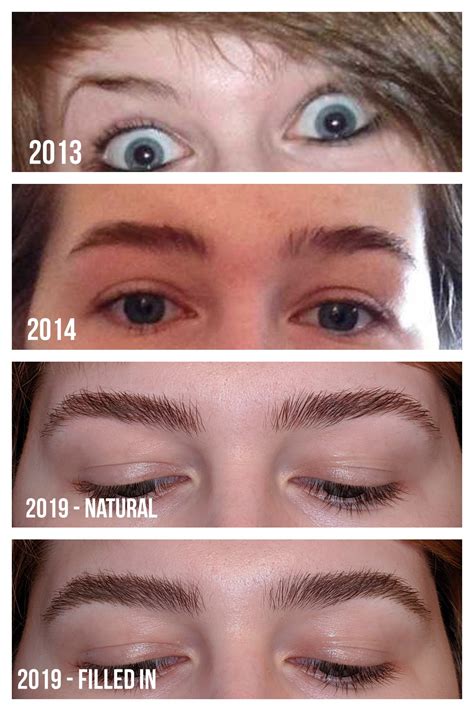 Minoxidil for Eyebrows
