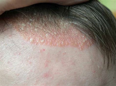 Minoxidil Skin Irritation
