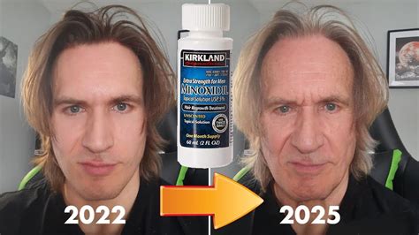 Minoxidil on the Face