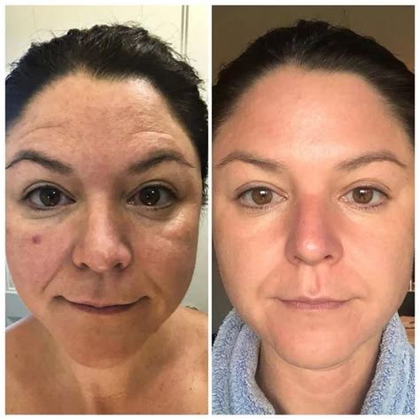 Unveiling the Mesmerizing Transformation of Modere Biocell Skin: A Before and After Journey to Radiant Youthful Glow