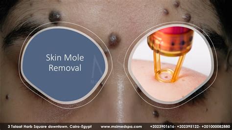 Mole Removal: Options & Recovery Tips