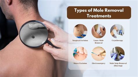 Mole Removal: Safe, Effective Methods Now.