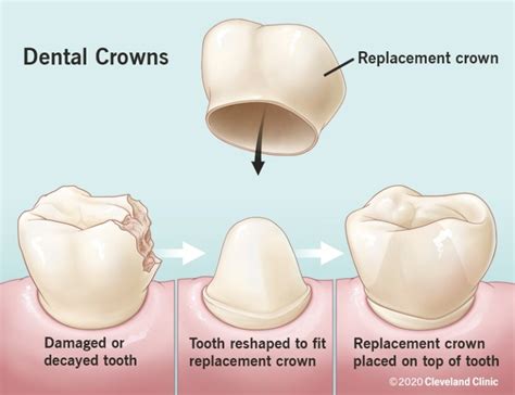Money Saving Tips on Crown Tooth Procedures