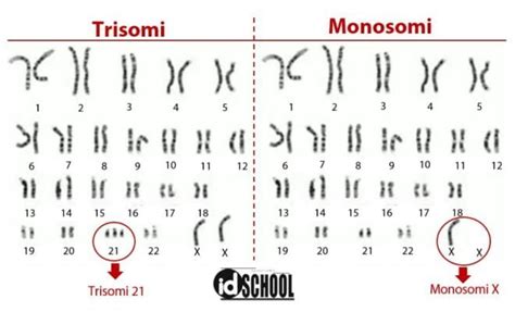 Monosomi: Keadaan Kromosom dengan Satu Kromosom