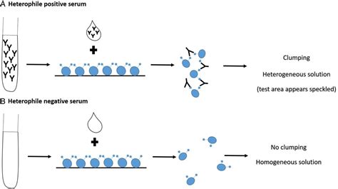 Monospot Test and interpretation