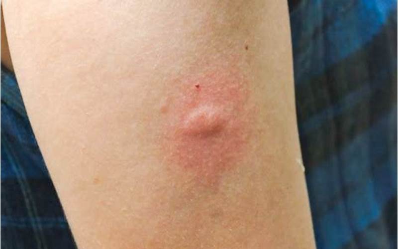 Mosquito Bite