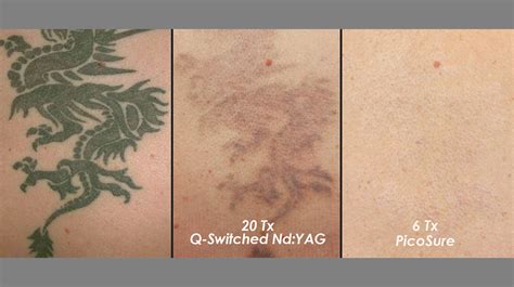 Laser Tattoo Removal · Professional, Effective · Lynton
