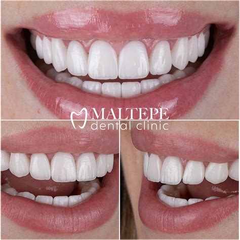 Unveiling the Awe-inspiring Aesthetics of Dental Perfection: Discovering the Most Beautiful Teeth Shape