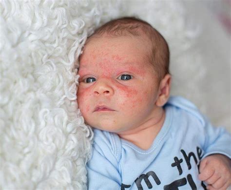 A Precious Bundle with a Mottled Skin - Embracing Your Beautifully Unique Baby