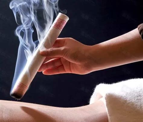 Moxibustion Therapy