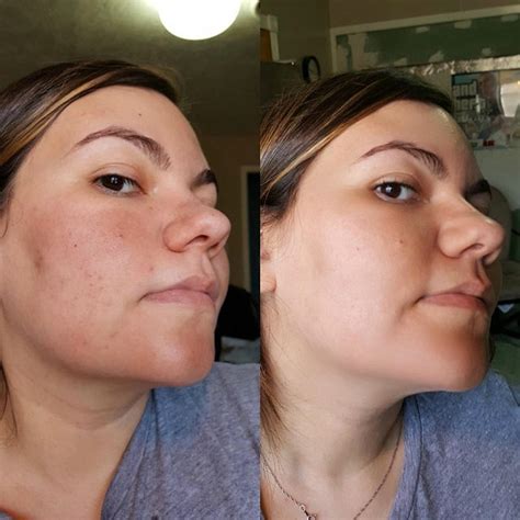Transform Your Skin with the Incredible Before and After Results of MSM!