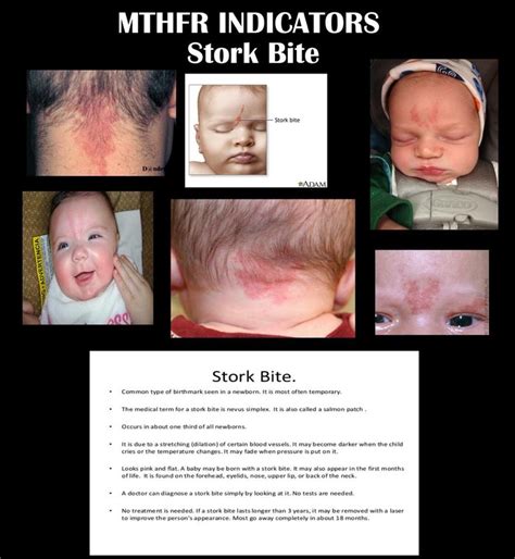 Mthfr Mutation Signs