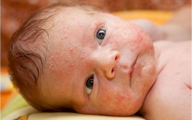 Muka Bayi Bintik Merah: Apakah Jerawat?