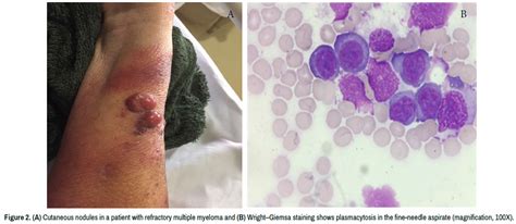 Unveiling the Mysteries of Multiple Myeloma Skin Nodules: A Comprehensive Guide