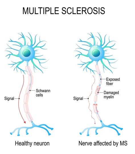 Sclerosis Diagram