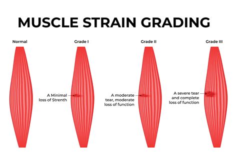 Muscle Strain