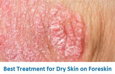 Revive your Manhood: How to Treat and Prevent Dry Penis Skin