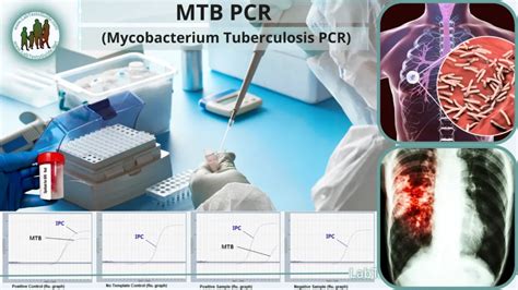 Mycobacterium Tuberculosis PCR Test and interpretation