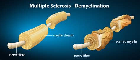 Myelin Sheath Repair