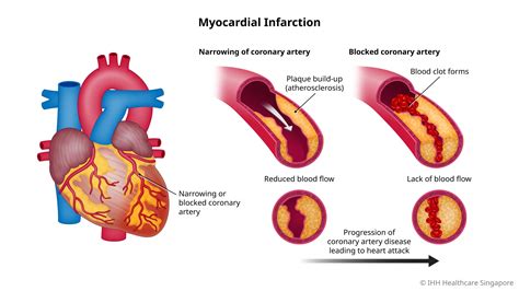 Myocardial Infraction