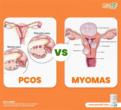 Myomas vs. Ovarian Cysts: Key Differences Explained.