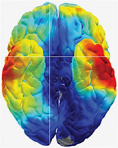 NIH Stroke Patient A: Cracking the Code of Brain Circuits