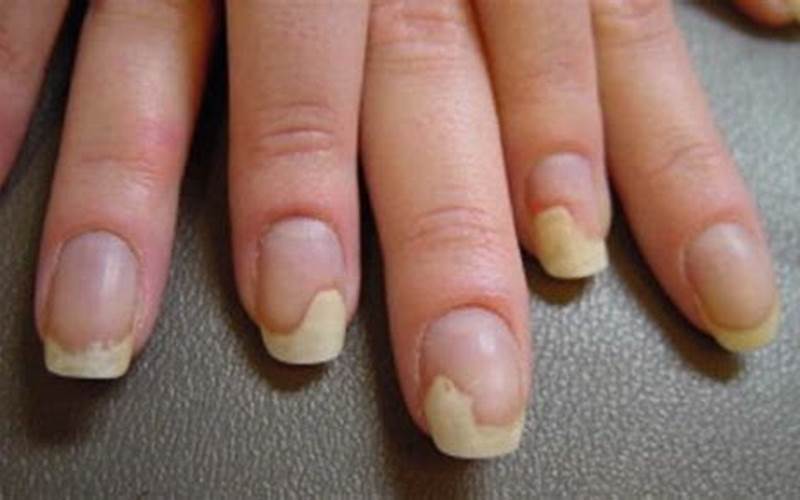 Nail Condition