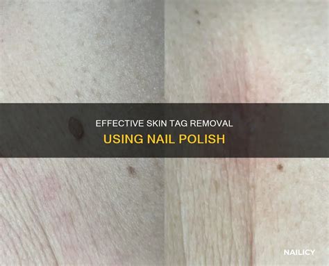 Glamorous Nail Polish Hacks for Effortless Skin Tag Removal
