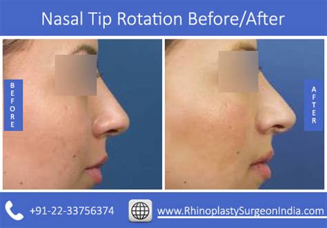 Improve Rhinoplasty Procedures with a Nasal Tip Rotation Calculator
