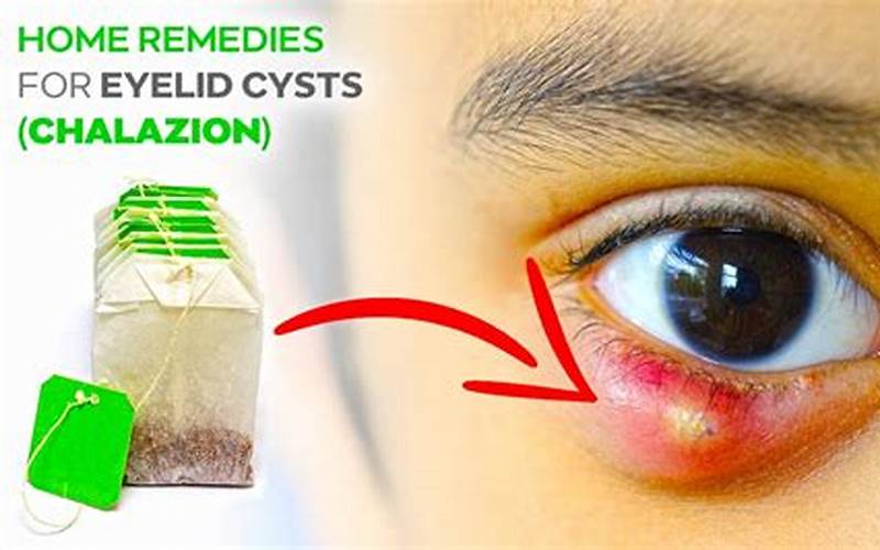 Natural Remedies For Chalazion