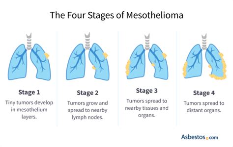 Navigating Advanced Mesothelioma Stages