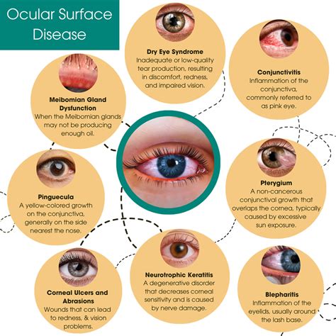 Navigating Common Eye Conditions and Treatments