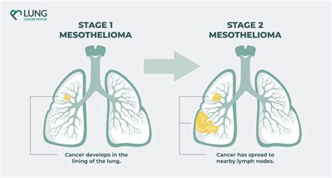 Navigating Life with Mesothelioma