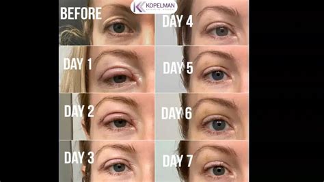 Navigating the Cat Eye Operation Recovery Process