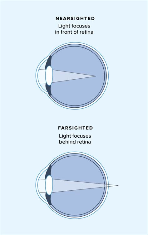 Clearing the Blur: Diving into the Definitions of Nearsightedness and Farsightedness - An Eye-Opening Guide