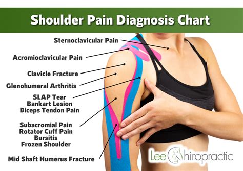 Neck And Shoulder Pain Chart
