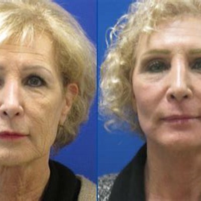 Neck Lifts and Laser Resurfacing