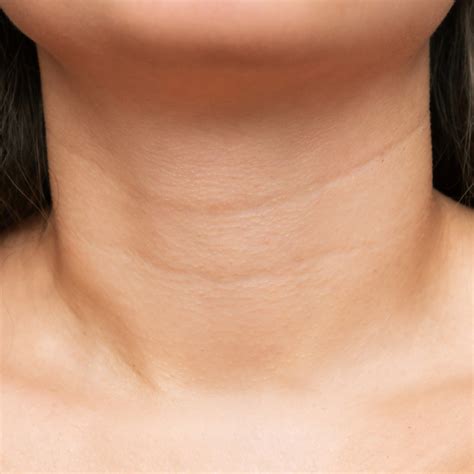 Neck Lines: Causes & Effective Treatments