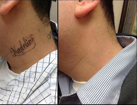 Neck Tattoo Complete Removal Clean Slate Laser Tattoo