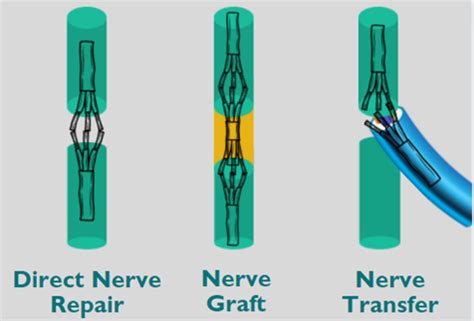Nerve repair surgery techniques