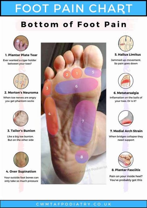 Neuroma Foot Pain Chart