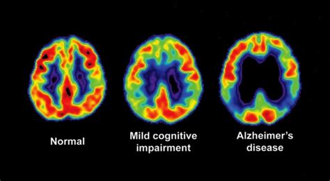 Alzheimer’s Cognitive Dysfunction Linked to Clotting Factor