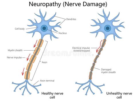 Neuropathy and Nerve Damage