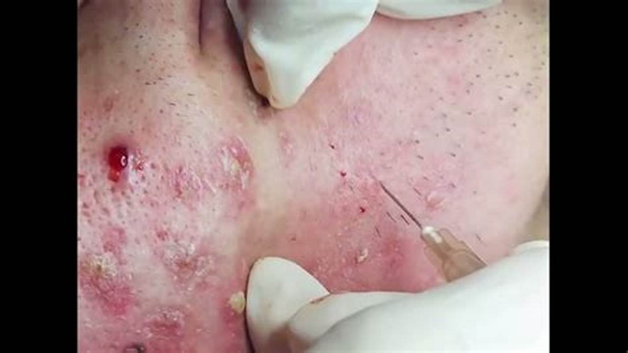 New Blackhead Removal Sept 1 2025
