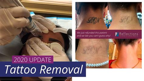 New Tattoo Removal Technology 2018 totalegossip