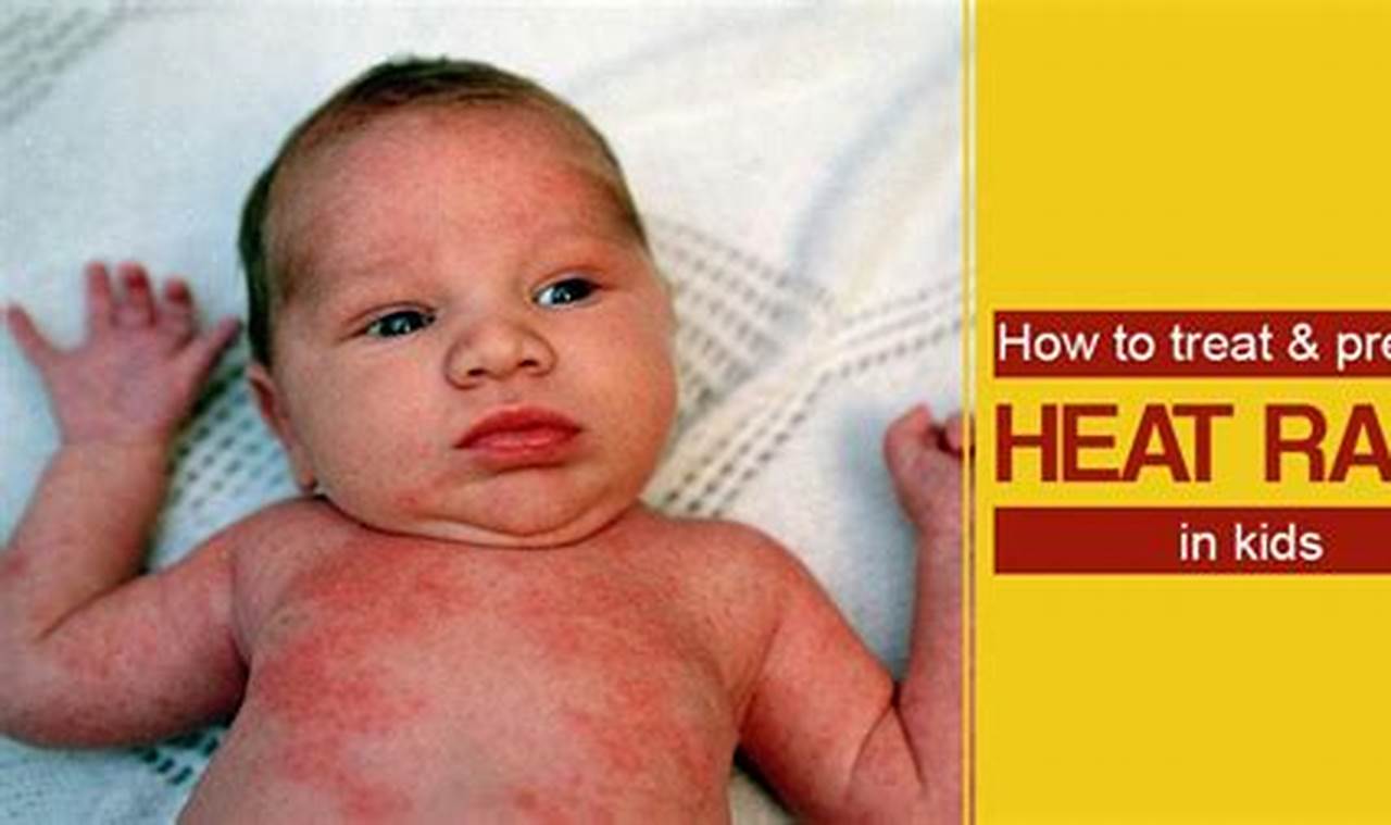 Newborn heat rash prevention and treatment